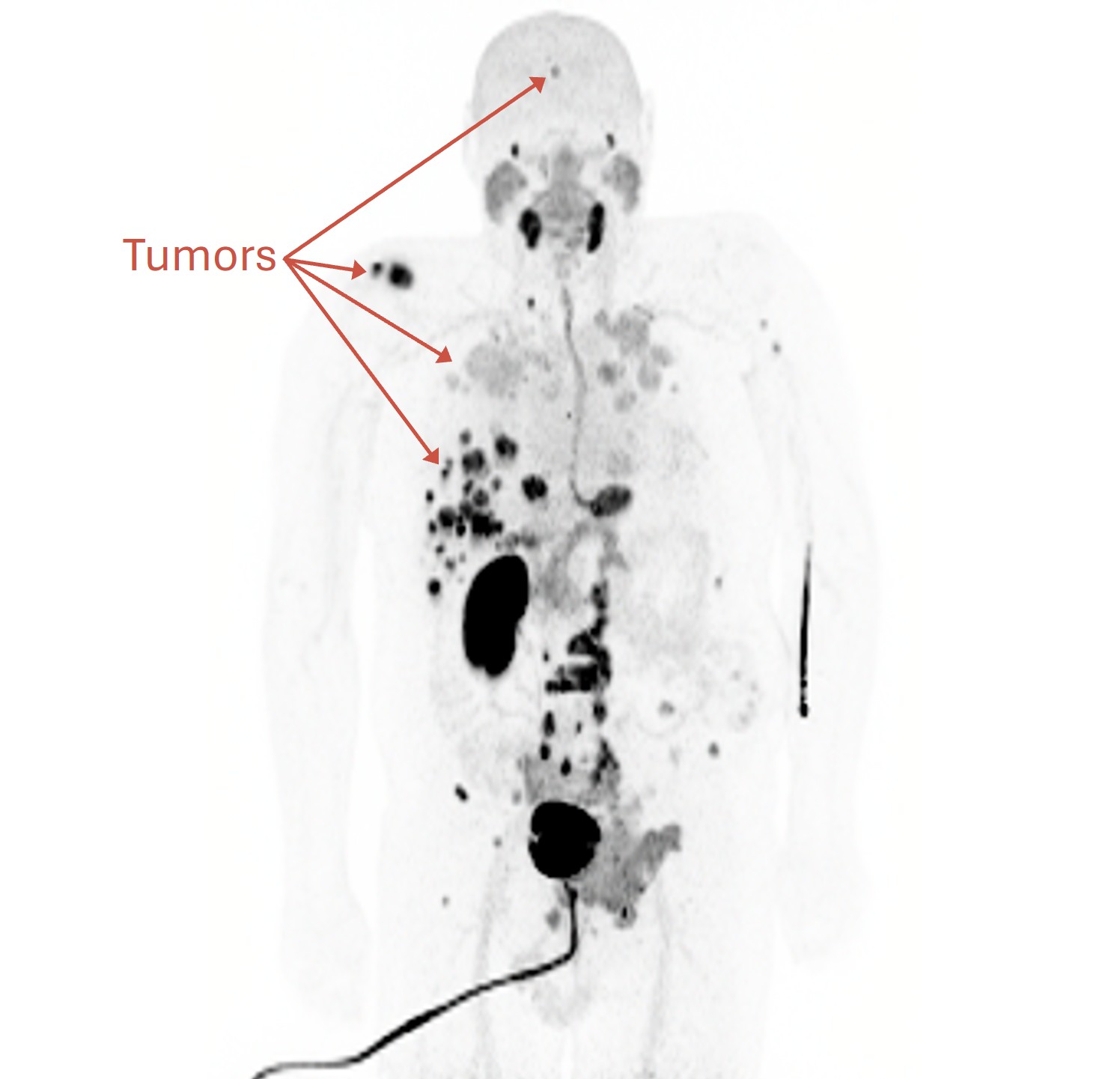 human body scan showing where tumors are located